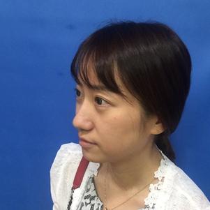 蚌埠韓美美萊整形做玻尿酸面部除皺效果怎么樣？附陳澤醫(yī)生案例效果圖