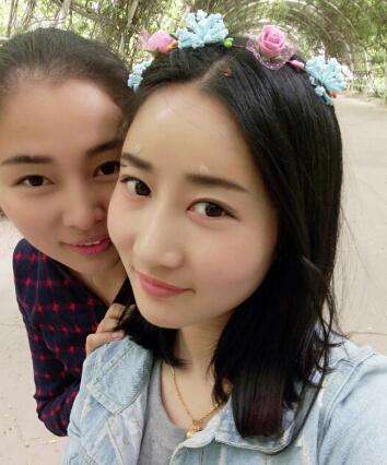 鞍山菲之都整形醫(yī)生李宗亮做字體脂肪豐太陽穴效果怎么樣？附案例效果對比圖