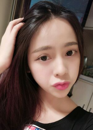 鞍山王景醫(yī)療美容外科診所做自體脂肪豐蘋果肌效果怎么樣？附張婉鸝案例效果圖