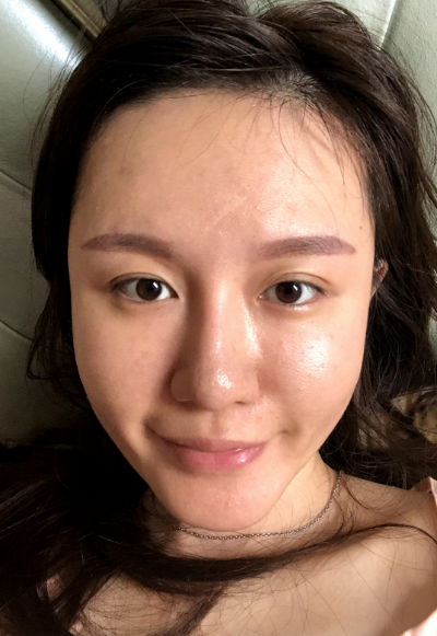 蚌埠韓美美萊整形醫(yī)生張燕做自體脂肪豐面頰效果怎么樣？附案例效果圖