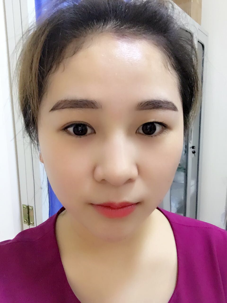 蚌埠韓美美萊整形醫(yī)生鄭捷做開眼角怎么樣？附案例效果圖