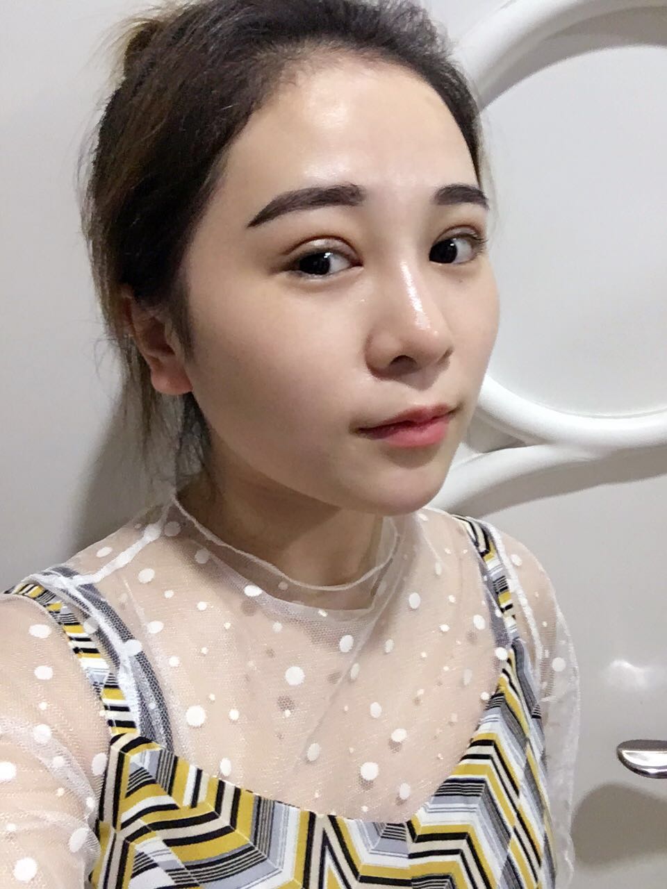 蚌埠韓美美萊整形醫(yī)生鄭捷做開眼角怎么樣？附案例效果圖