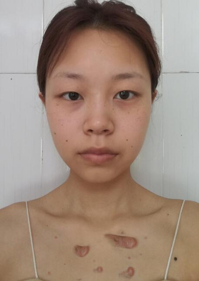 安陽(yáng)市人民醫(yī)院燒傷整形中心做手術(shù)激光祛斑效果怎么樣？附案例效果對(duì)比圖