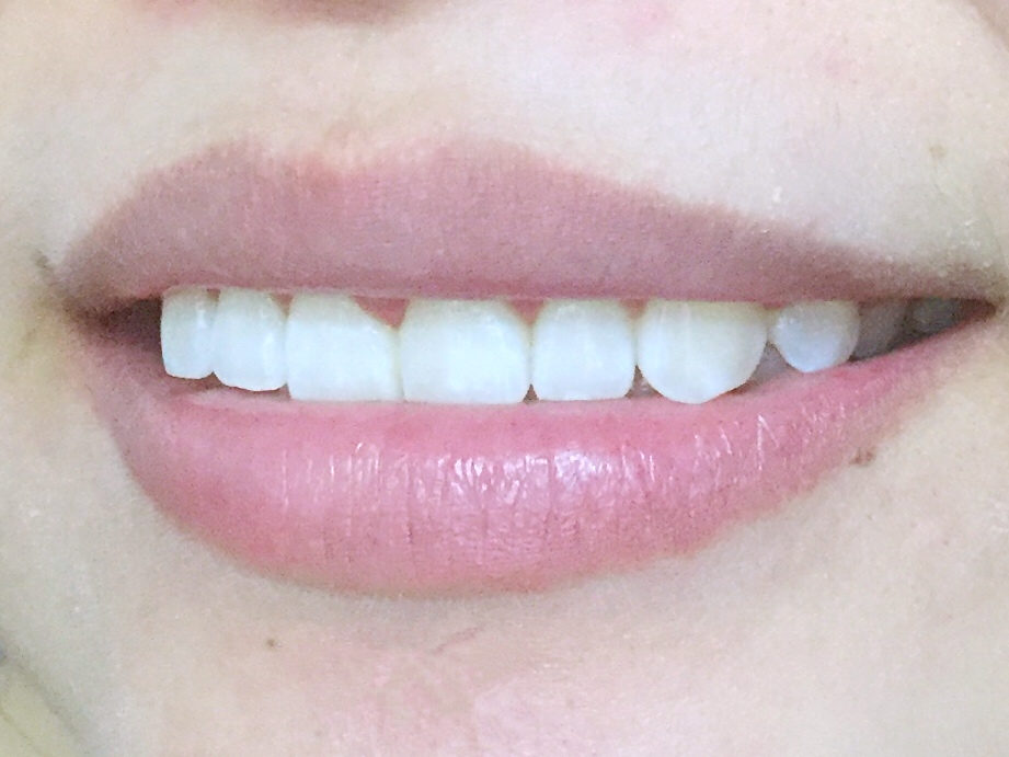 安慶渡江口腔醫(yī)院張良斌醫(yī)生做超聲波洗牙效果怎么樣？附洗牙案例效果圖