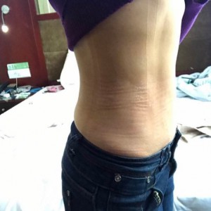 蚌埠韓美美萊整形醫(yī)生張濤做水動力吸脂怎么樣？附吸脂案例效果圖