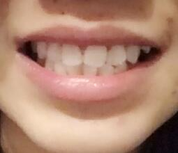 鞍山時(shí)代口腔門(mén)診部劉昕醫(yī)生做美容冠效果怎么樣？一起來(lái)看看吧