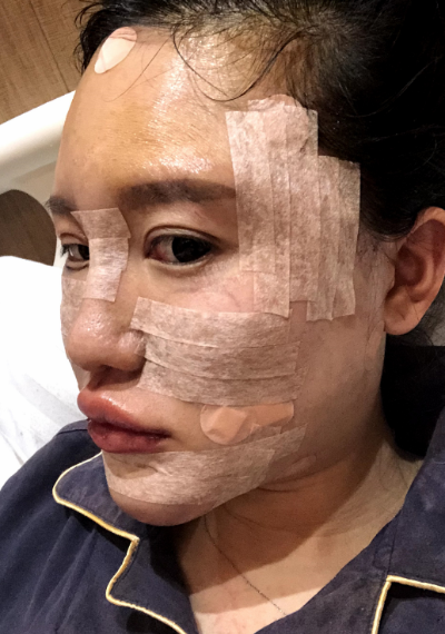 蚌埠韓美美萊整形醫(yī)生張燕做自體脂肪豐面頰效果怎么樣？附案例效果圖