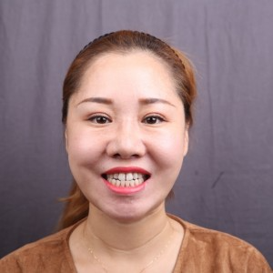 保定東陽口腔醫(yī)院趙晨醫(yī)生做瓷貼面怎么樣？附瓷貼面案例效果對比圖