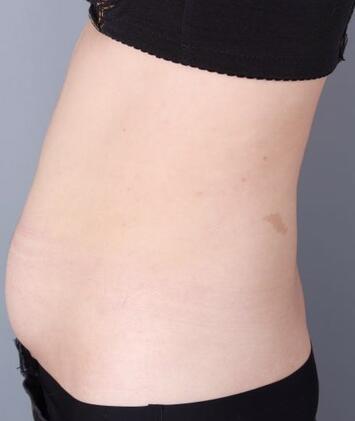 保定現(xiàn)代女子醫(yī)院整形美容中心做腰腹部吸脂怎么樣？附林秀蓮醫(yī)生案例效果圖