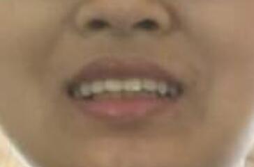 保定東陽口腔醫(yī)院馮春城醫(yī)生做烤瓷牙怎么樣?附烤瓷牙案例效果對比圖