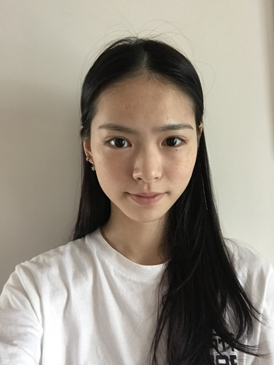 保定市第五醫(yī)院美容整形科做激光祛斑怎么樣？附單敬依醫(yī)生案例效果圖