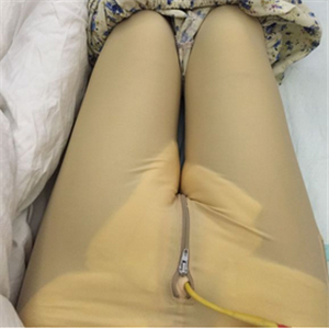 保定市第五醫(yī)院美容整形科做大腿吸脂怎么樣？附劉根立醫(yī)生案例效果圖