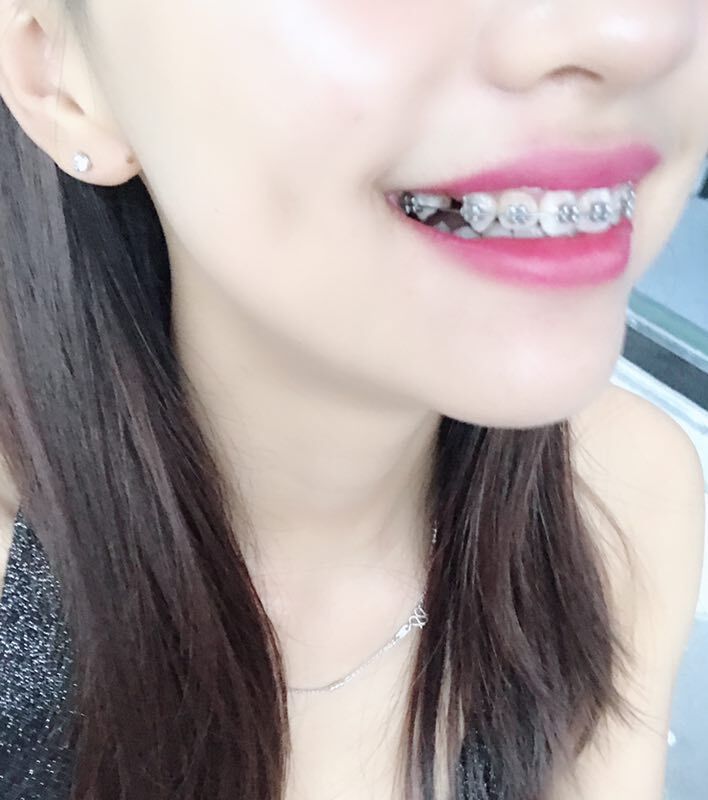 保定東陽口腔醫(yī)院溫興醫(yī)生做牙齒矯正怎么樣？附牙齒矯正案例效果對比圖