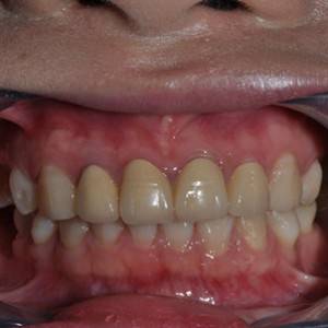 保定東陽口腔醫(yī)院張亞靜醫(yī)生做牙齒冷光美白怎么樣？附冷光美白案例效果對比圖