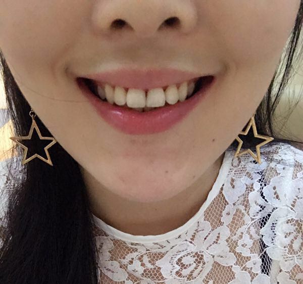 保定東陽(yáng)口腔醫(yī)院白小青醫(yī)生做牙齒矯正怎么樣?附牙齒矯正案例效果對(duì)比圖