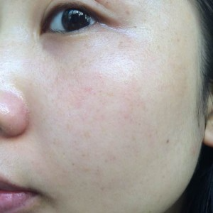 寶雞皮膚病醫(yī)院文東亮醫(yī)生做臉部祛斑效果怎么樣？附臉部祛斑案例