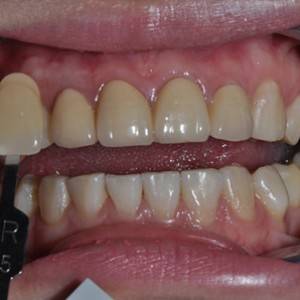 保定東陽口腔醫(yī)院張亞靜醫(yī)生做牙齒冷光美白怎么樣？附冷光美白案例效果對比圖