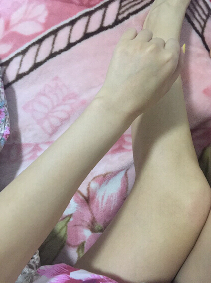 蚌埠市第三人民醫(yī)院燒傷整形科李方奇注射美白針效果怎么樣？安全嗎？附案例