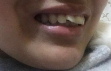 保定東陽口腔醫(yī)院馮春城醫(yī)生做烤瓷牙怎么樣？附烤瓷牙案例效果對比圖