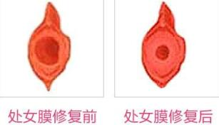 蚌埠市第三人民醫(yī)院燒傷整形科許瑾醫(yī)生做處女摸修復怎么樣？附案例