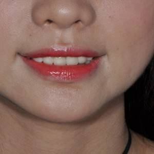 保定東陽口腔醫(yī)院張亞靜醫(yī)生做牙齒冷光美白怎么樣？附冷光美白案例效果對比圖