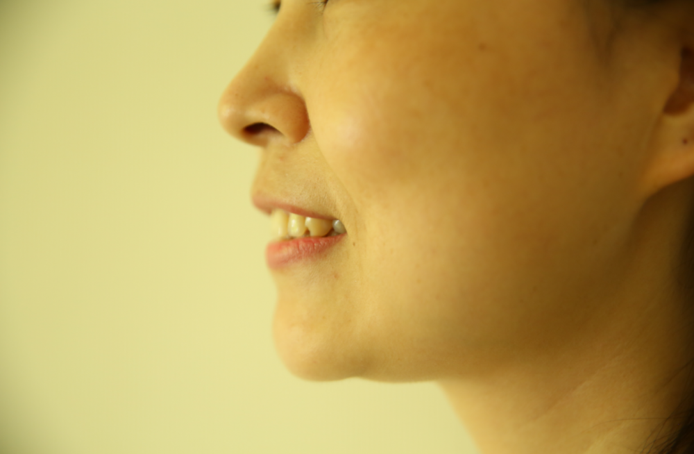 保定東陽口腔醫(yī)院趙星醫(yī)生做牙齒瓷貼面怎么樣？附牙齒瓷貼面案例效果對比圖