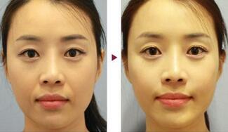 保定安卓貝拉做注射去法令紋怎么樣？附儲(chǔ)君醫(yī)生法令紋案例效果圖