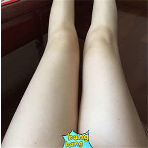 保定市第五醫(yī)院美容整形科做大腿吸脂怎么樣？附劉根立醫(yī)生案例效果圖