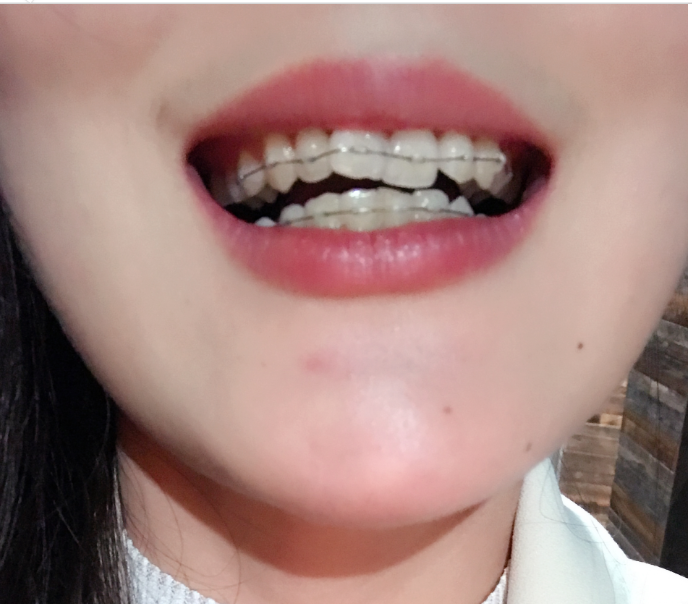 保定東陽(yáng)口腔醫(yī)院白小青醫(yī)生做牙齒矯正怎么樣?附牙齒矯正案例效果對(duì)比圖