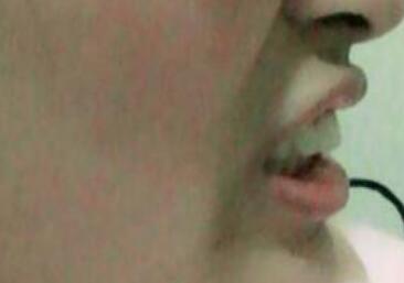 保定東陽口腔醫(yī)院馮春城醫(yī)生做烤瓷牙怎么樣?附烤瓷牙案例效果對比圖