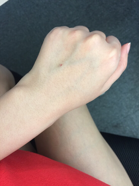 蚌埠市第三人民醫(yī)院燒傷整形科李方奇注射美白針效果怎么樣？安全嗎？附案例