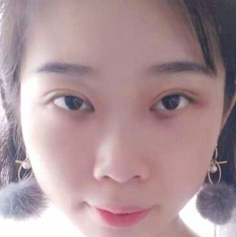 保定安卓貝拉醫(yī)療美容門(mén)診部孫大山醫(yī)生做雙眼皮+去眼袋怎么樣？附案例效果對(duì)比圖