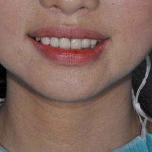 保定東陽口腔醫(yī)院張亞靜醫(yī)生做牙齒冷光美白怎么樣？附冷光美白案例效果對比圖