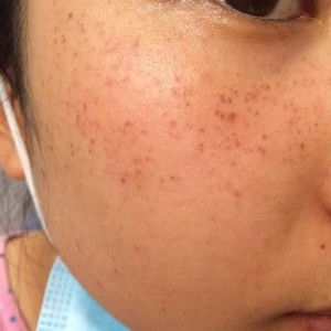 寶雞皮膚病醫(yī)院文東亮醫(yī)生做臉部祛斑效果怎么樣？附臉部祛斑案例