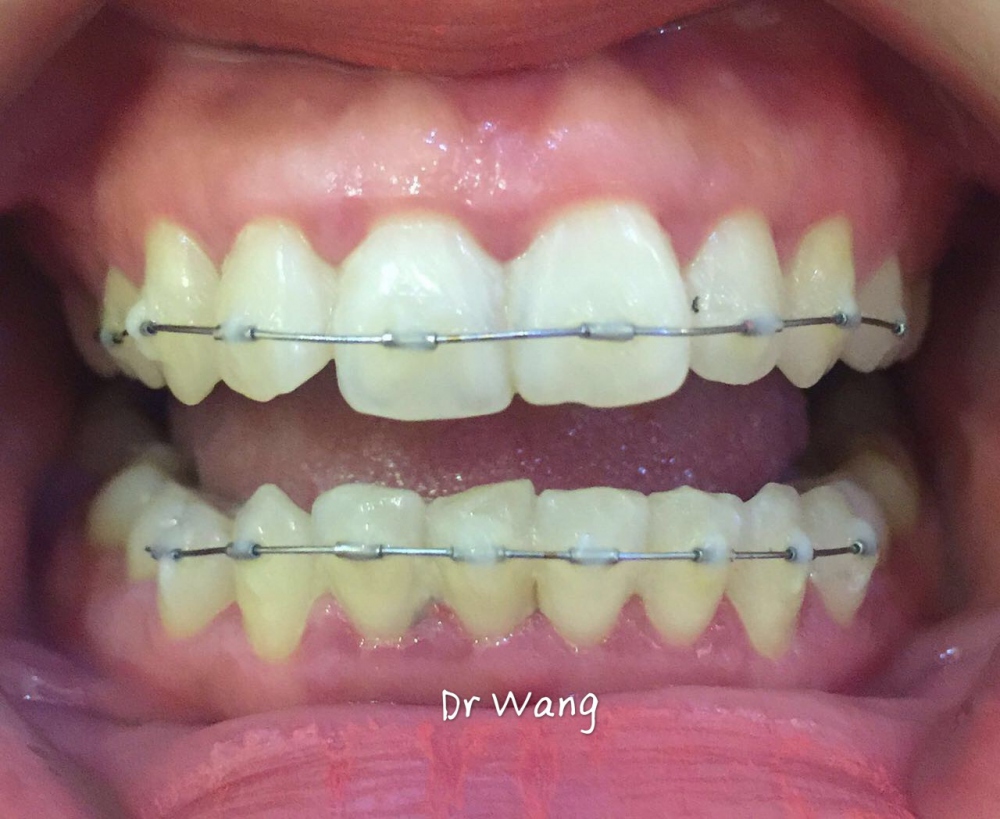 保定東陽(yáng)口腔醫(yī)院白小青醫(yī)生做牙齒矯正怎么樣?附牙齒矯正案例效果對(duì)比圖