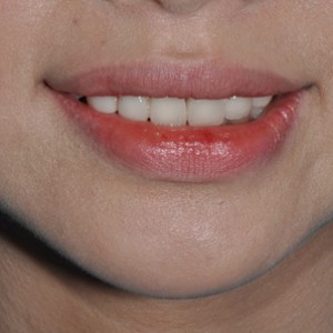 保定東陽口腔醫(yī)院張亞靜醫(yī)生做牙齒冷光美白怎么樣？附冷光美白案例效果對比圖