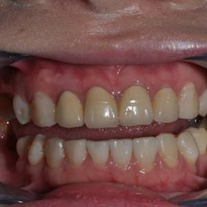 保定東陽口腔醫(yī)院張亞靜醫(yī)生做牙齒冷光美白怎么樣？附冷光美白案例效果對比圖