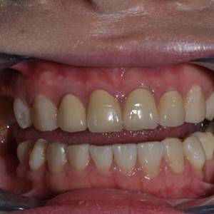 保定東陽口腔醫(yī)院張亞靜醫(yī)生做牙齒冷光美白怎么樣？附冷光美白案例效果對比圖