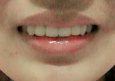 保定東陽口腔醫(yī)院馮春城醫(yī)生做烤瓷牙怎么樣?附烤瓷牙案例效果對比圖