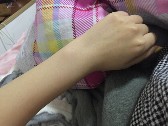 蚌埠市第三人民醫(yī)院燒傷整形科李方奇注射美白針效果怎么樣？安全嗎？附案例