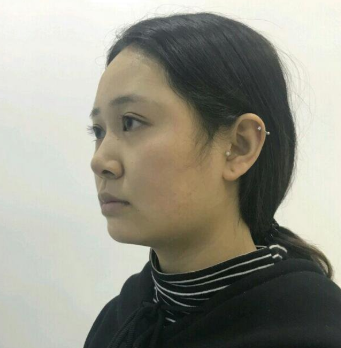 汕頭名流整形美容醫(yī)院假體隆下巴手術(shù)前效果