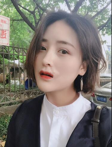 蘇州愛思特醫(yī)療美容醫(yī)院自體脂肪隆鼻手術(shù)后效果