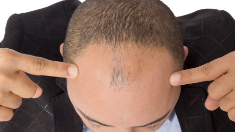 毛發(fā)種植多久能長出來？