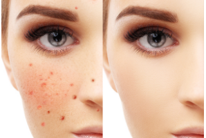 激光祛斑的一般價(jià)格是多少？