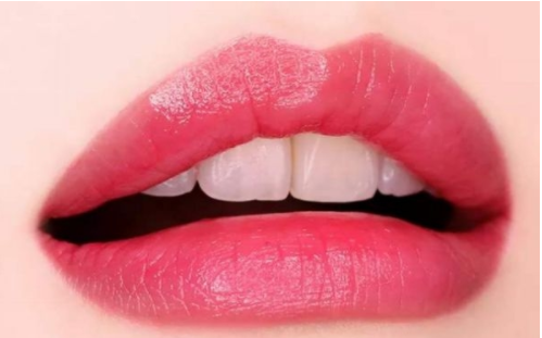 玻尿酸豐唇能保持多長時(shí)間？保持效果時(shí)間長嗎？