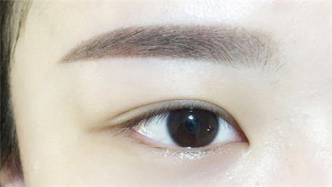 眼角修復手術(shù)多少錢？術(shù)后多久能恢復？