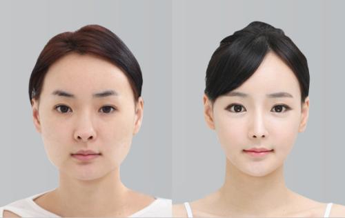 想做歐式雙眼皮，什么是歐式雙眼皮？