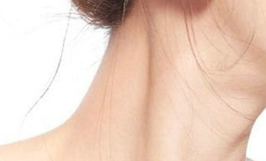 頸紋太深怎么辦?去除頸紋一般需要多少錢？