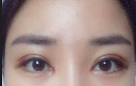 全切雙眼皮多少錢一次？全切雙眼皮后遺癥有哪些？