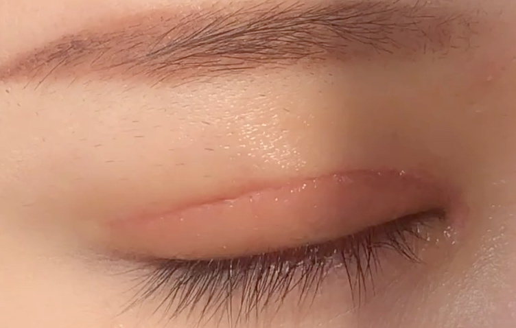 全切雙眼皮有哪些優(yōu)點(diǎn)？